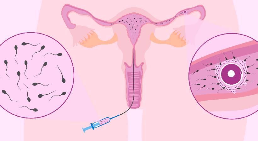 IUI Treatment in Pune
